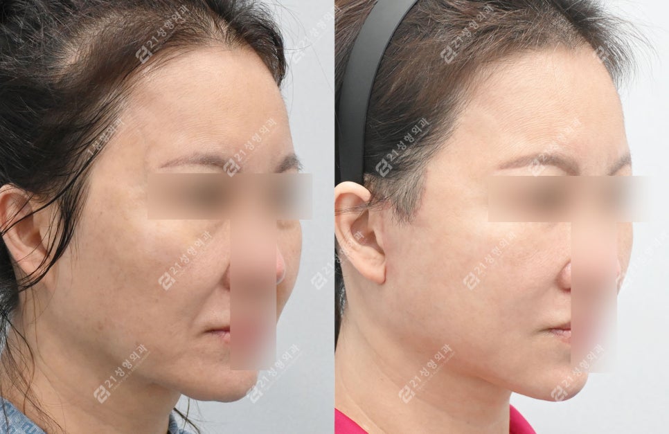 A Face That Needed a Lift, Not a Thread Lift — and There Was a Reason image 6