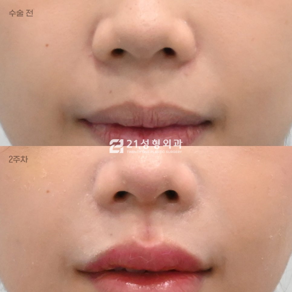 인중 흉터 없이 짧아 보이는 법? 성형외과 원장이 밝히는 인중 라인 착시 효과 관련 이미지 1