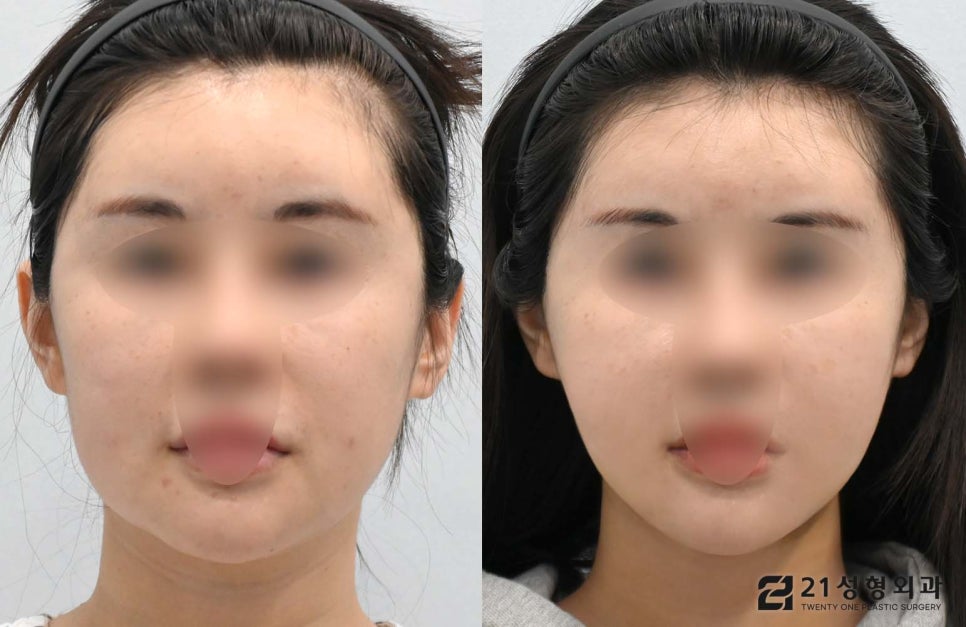 투턱없애기 이중턱근육묶기로 해결 관련 이미지 1