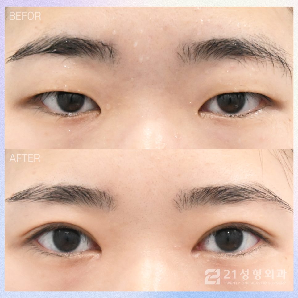 절개쌍꺼풀을 통한 자연스러운 라인 관련 이미지 1