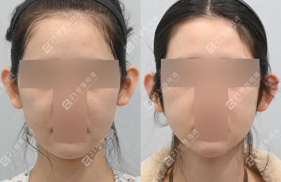 이중턱 수술 후 턱밑 피부가 접혔는데 이게 정상이라고요? 관련 이미지 2