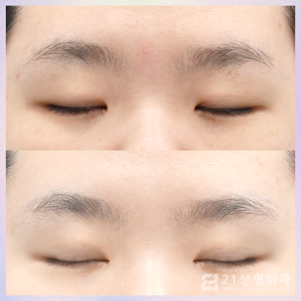 강남쌍꺼풀수술잘하는곳 찾아보는 포인트 관련 이미지 2