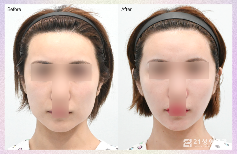 미니거상수술, 안면거상과의 차이점 관련 이미지 1