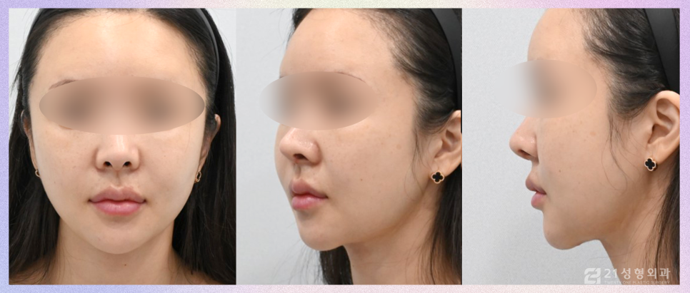 코성형잘하는곳 전체적인 비율을 고려해야 관련 이미지 7