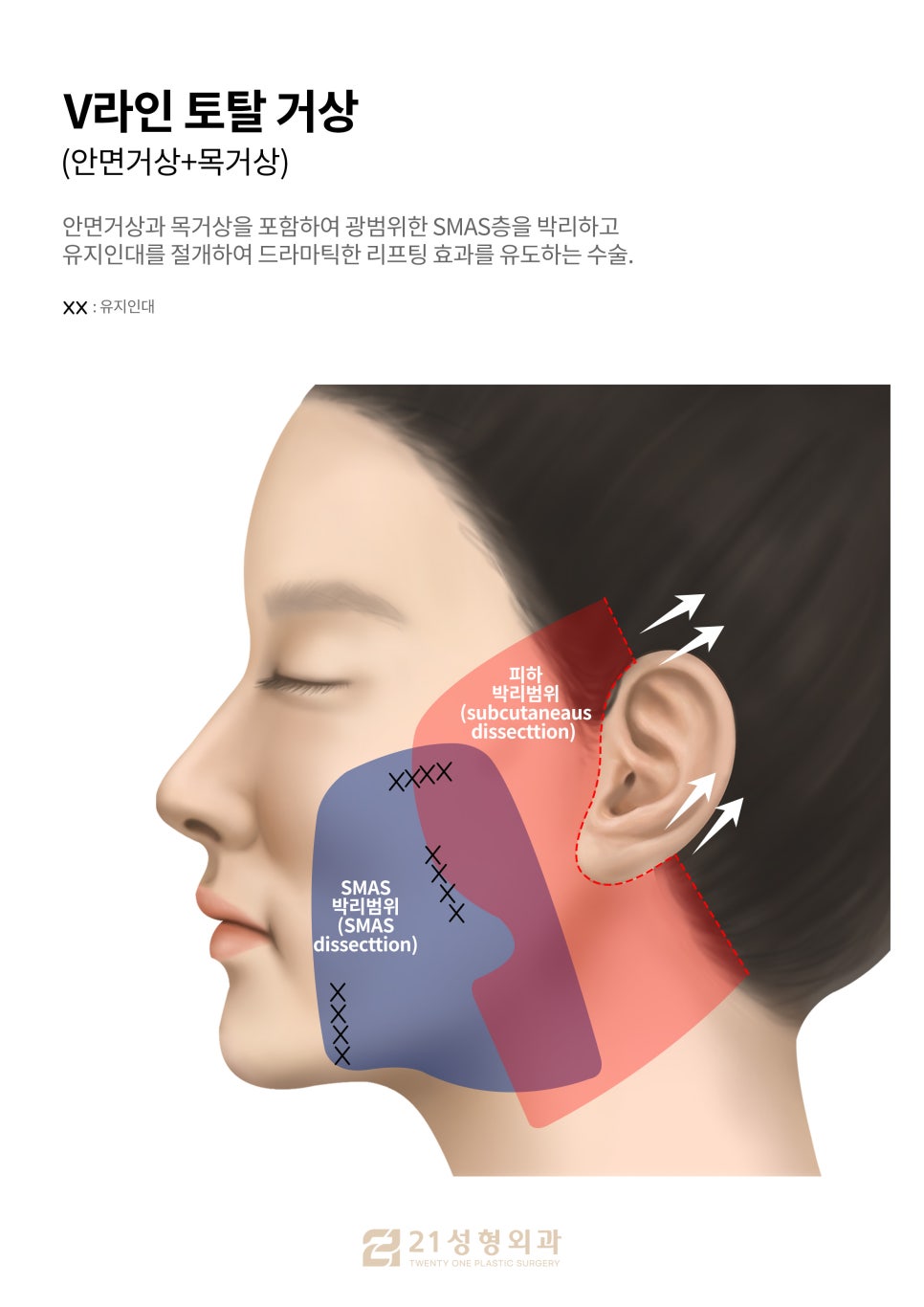 Face and Neck Lift: What Matters More Than Scars Is the Surgical Design image 2