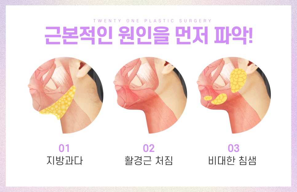 투턱지방흡입 이중턱없는 매끈한 턱 라인이 필요할 때 관련 이미지 4
