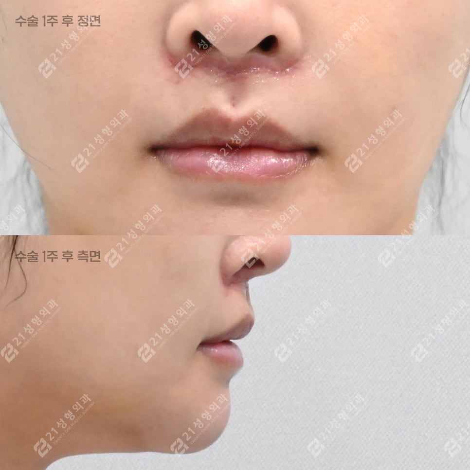 A Lip-Philtrum Reduction Surgery Case: Why Philtrum Dimple Surgery Was Performed Together image 4