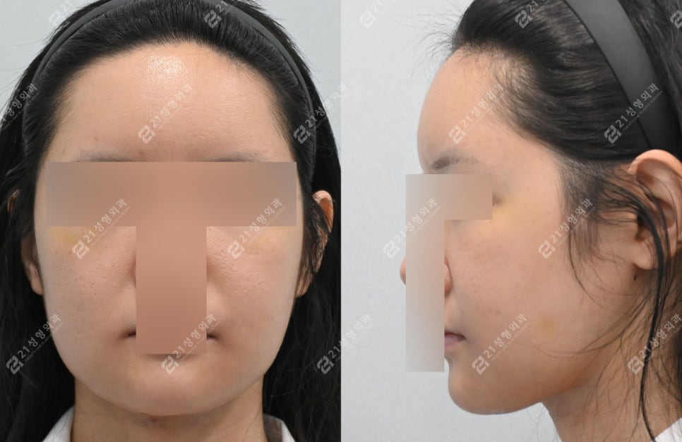 Double Chin Surgery, There Was Actually Another Cause (Real Case Analysis) image 3