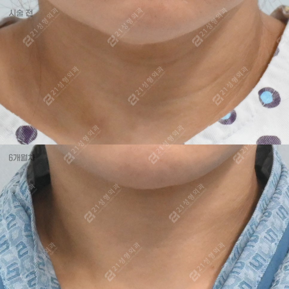 That Posture You Use While Looking at Your Smartphone—Half of Your Neck Wrinkles Start There. — 21 Plastic Surgery Neck Wrinkle Treatment image 1