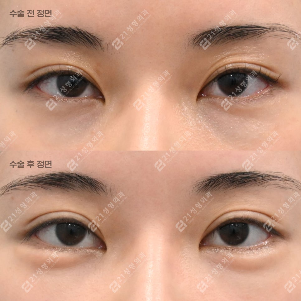 Key Points That Change Your Impression: Under-Eye Fat Repositioning and Nano-Pet Fat Grafting image 1