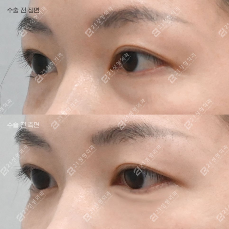 눈밑지방재배치, 30대인데 피곤해 보이는 이유 관련 이미지 5