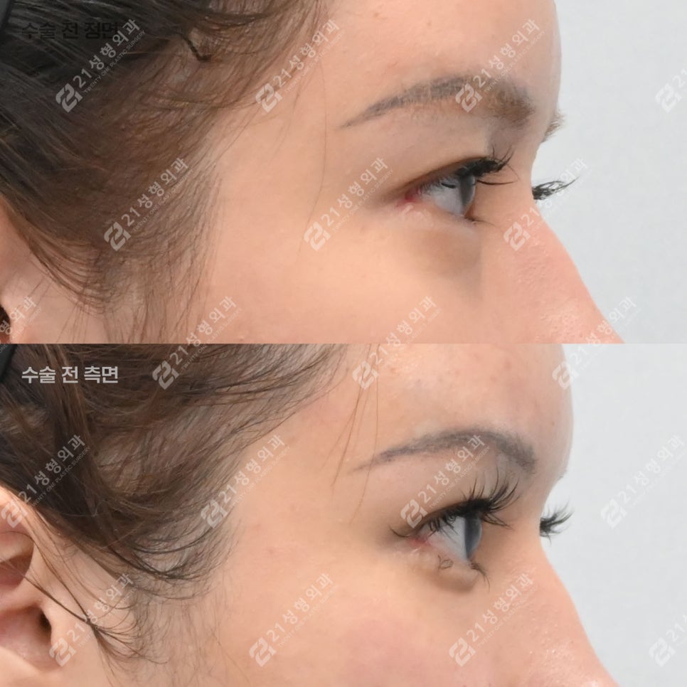 The Reason Lower Eyelid Fat Repositioning Is Needed, Explained Through the Structure Under the Eyes image 5