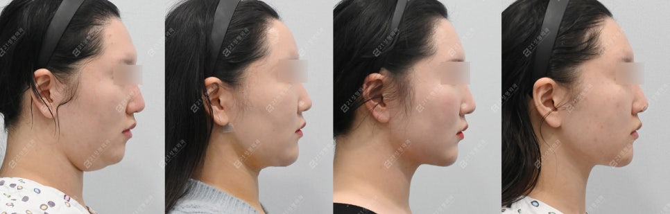얼굴지방흡입붓기 2개월차 전후경과 관련 이미지 5