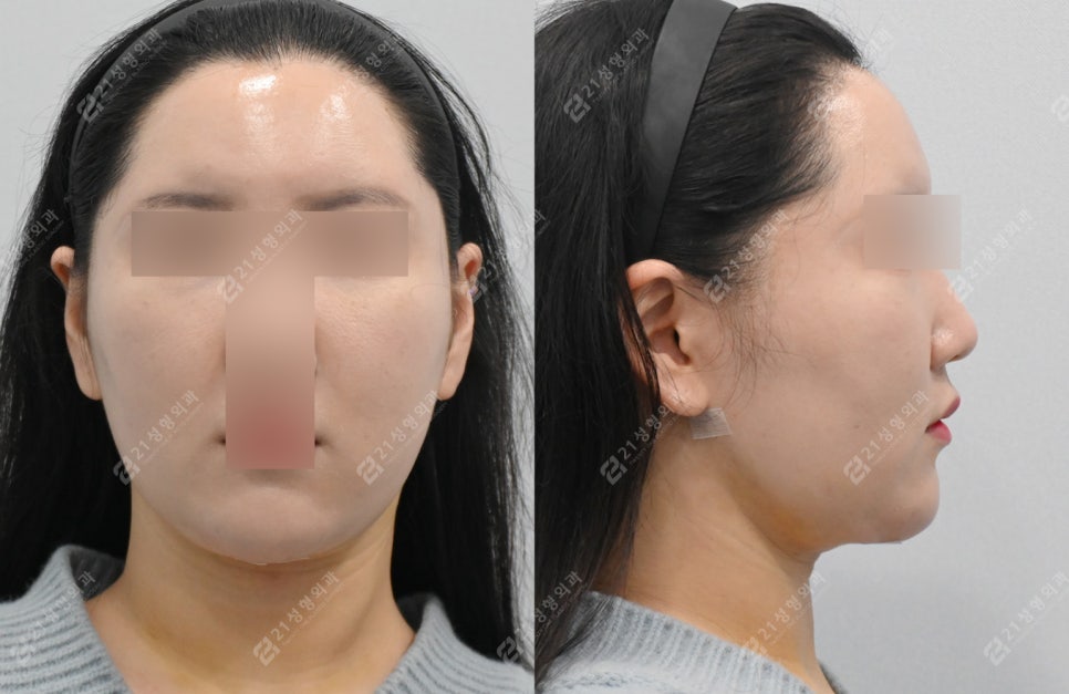 얼굴지방흡입붓기 2개월차 전후경과 관련 이미지 2