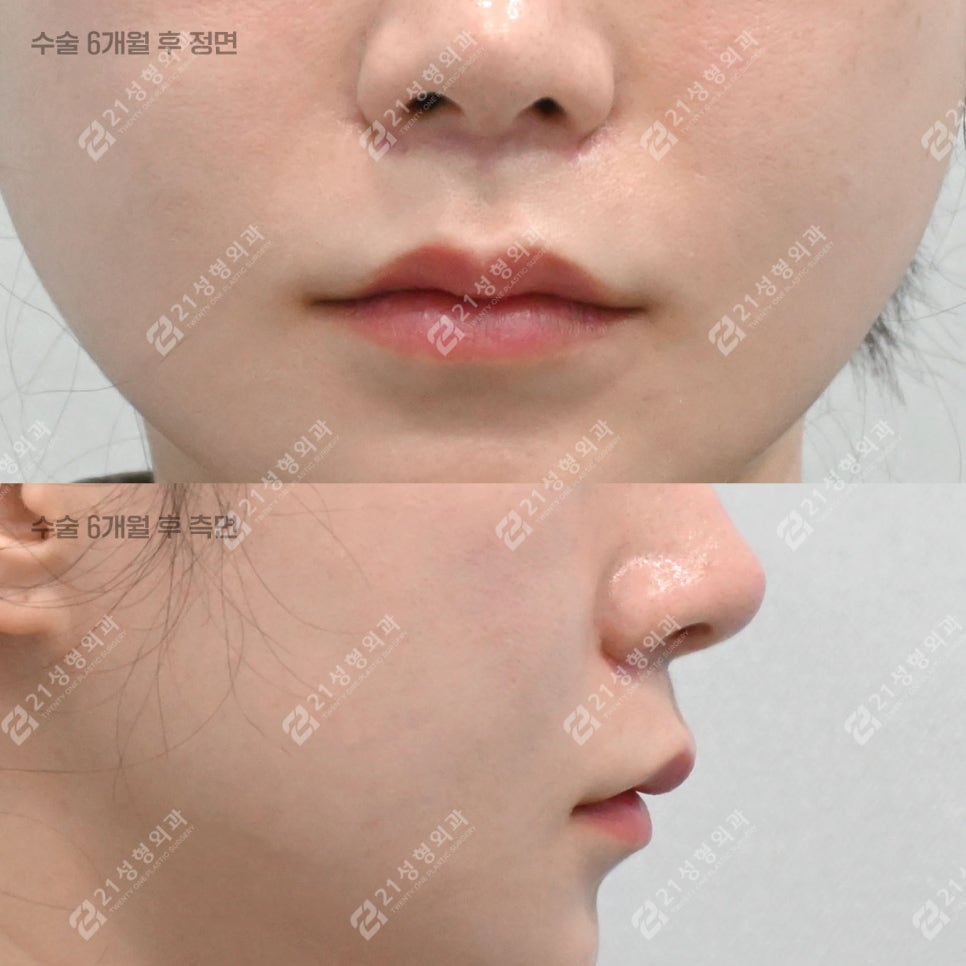 Lip Lift Review | What Matters More Than Length Is Facial Proportion! image 6