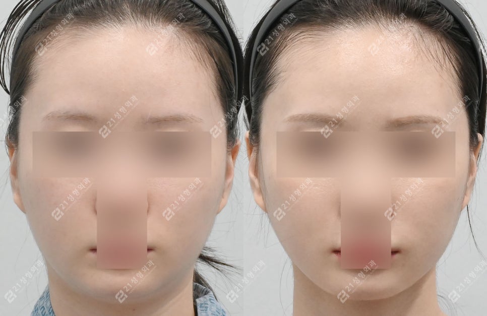 The Reason a Double Chin Appeared After Surgery Was Not a Fat Problem image 5