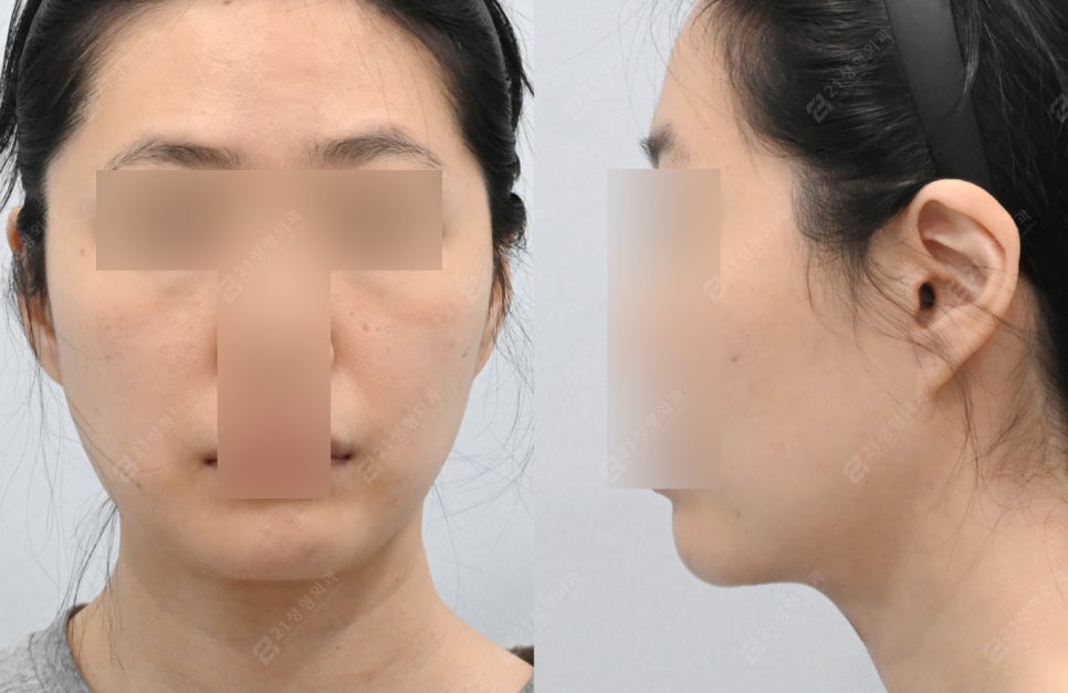 Is simple liposuction enough for double chin surgery? image 5