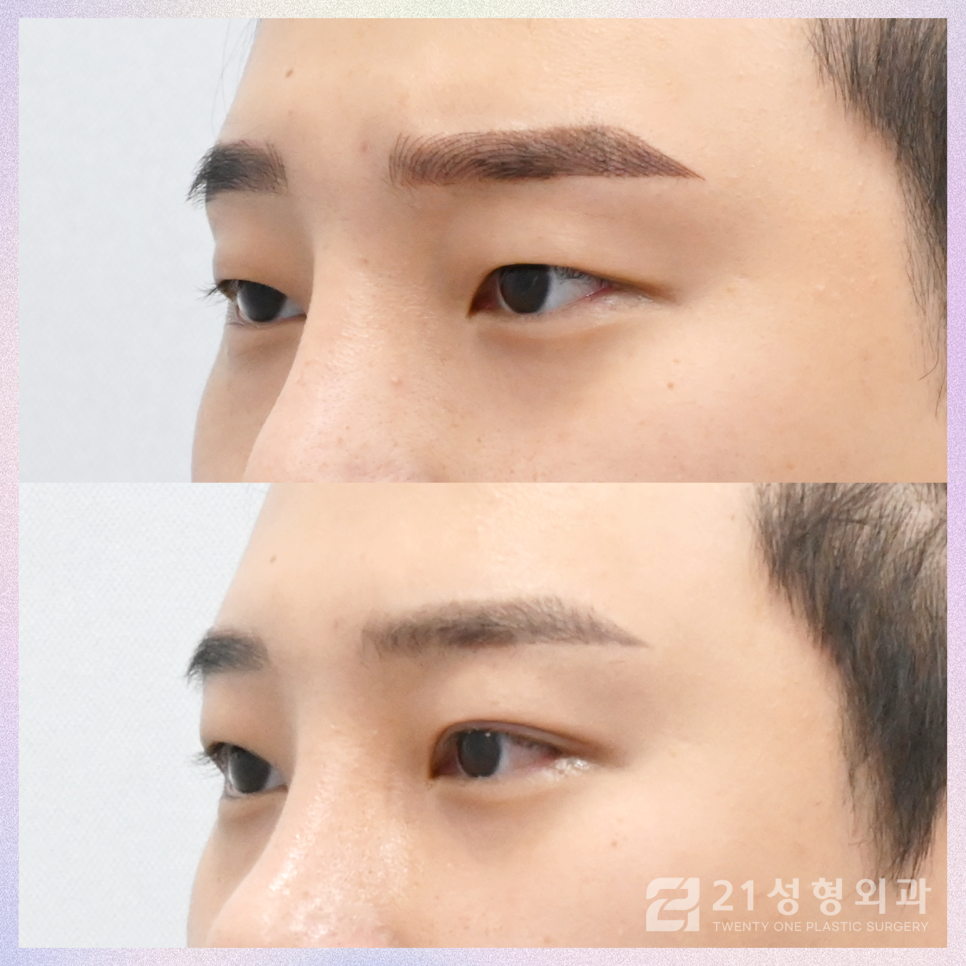 남자눈성형외과 결정에서 가장 중요한 핵심은 관련 이미지 3