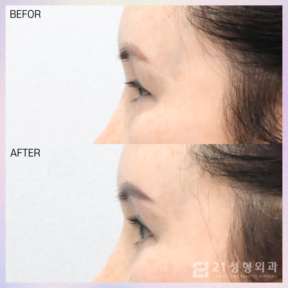 상안검수술흉터 걱정되신다면 관련 이미지 5
