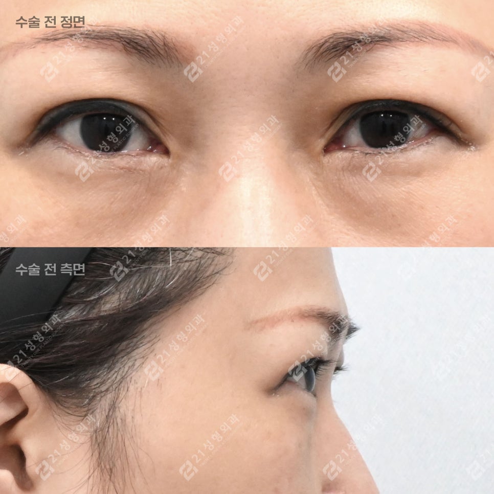 중년 눈성형, 눈썹하거상+하안검으로 자연스러운 동안 만들기! 관련 이미지 2
