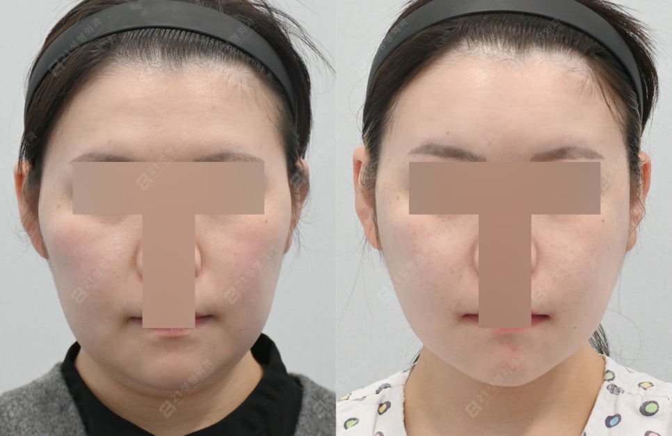 Can I Have a Clean Jawline Too? A Real Review of Double Chin Removal image 6