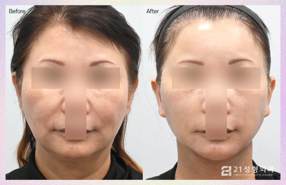 안면거상술잘하는곳 결정할 때 중요한 부분 관련 이미지 1
