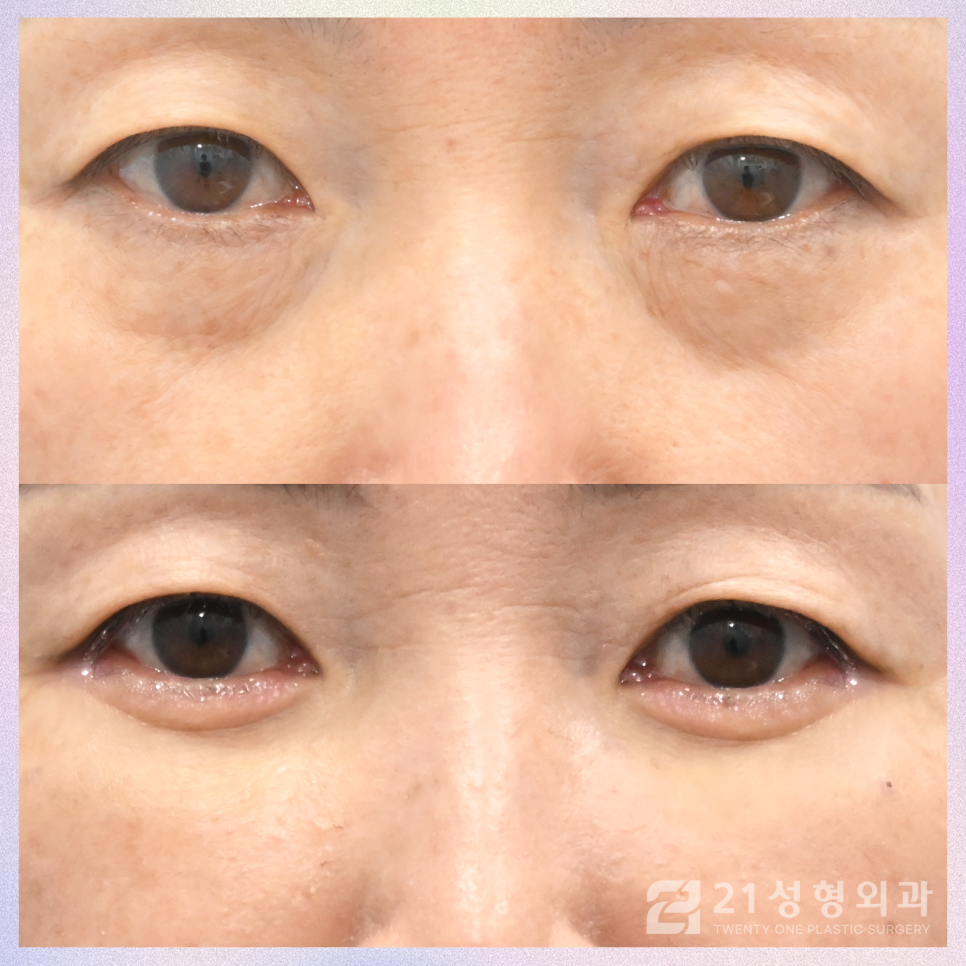 하안검수술후케어 젊음을 유지하기 위해서는 관련 이미지 1