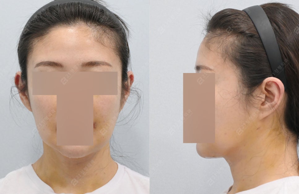Real Review: A Smooth Improvement of Leftover Double Chin and Jowl Fat Even After Dieting image 3