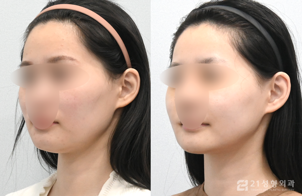 안면윤곽잘하는병원 선택할 때 중요한 점 관련 이미지 2