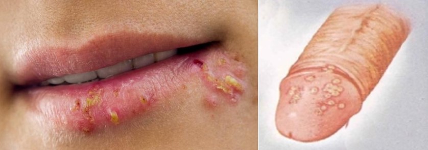 [항 바이러스제] herpes virus (헤르페스 바이러스) ② 관련 이미지 8