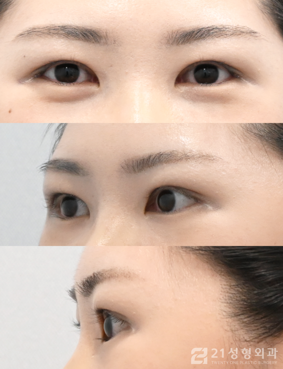 눈매교정병원 자연스러운 눈의 차이 관련 이미지 5