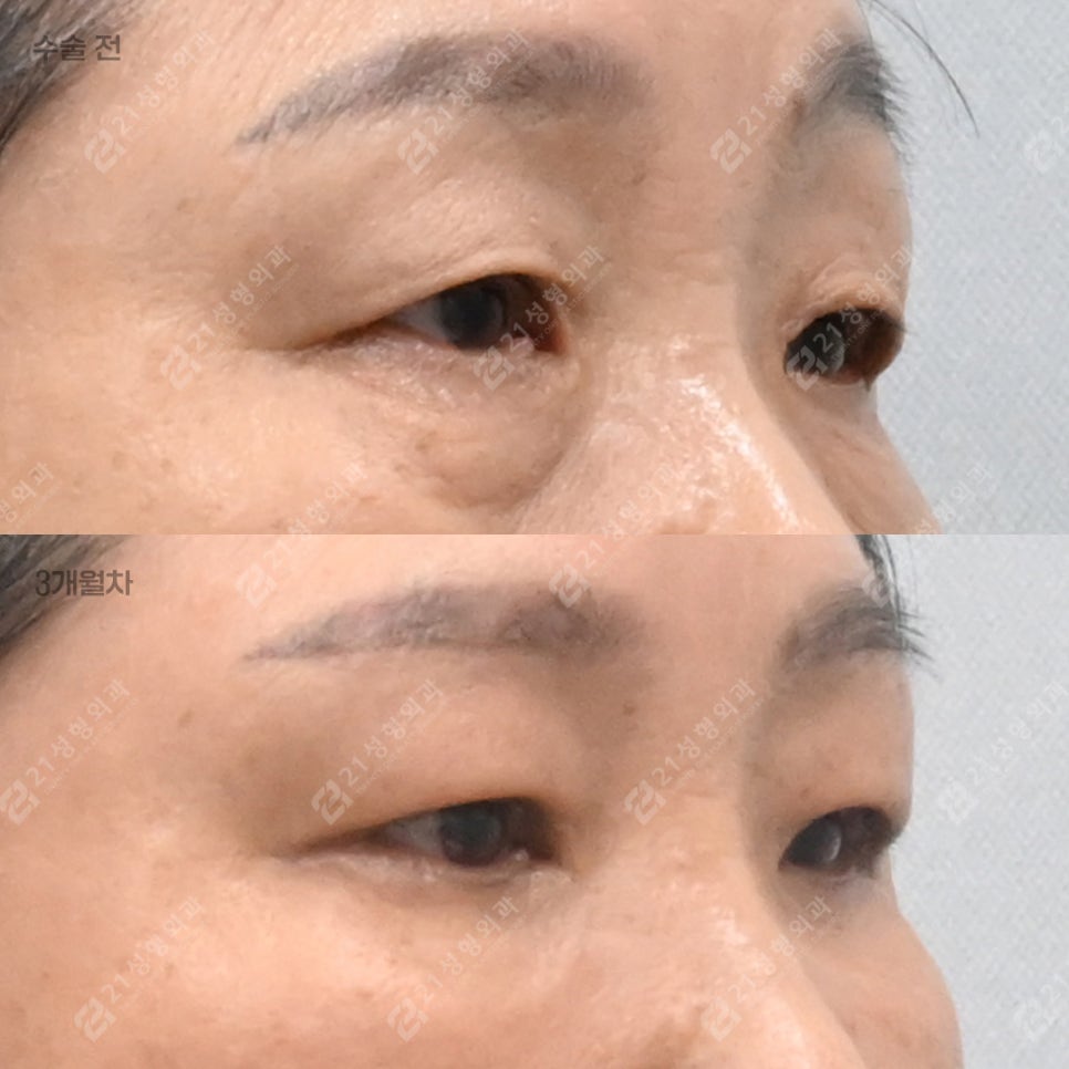 Do Your Eyes Feel Heavy and Constricted? 21 Plastic Surgery Explains How to Self-Assess for a Sub-Brow Lift image 2