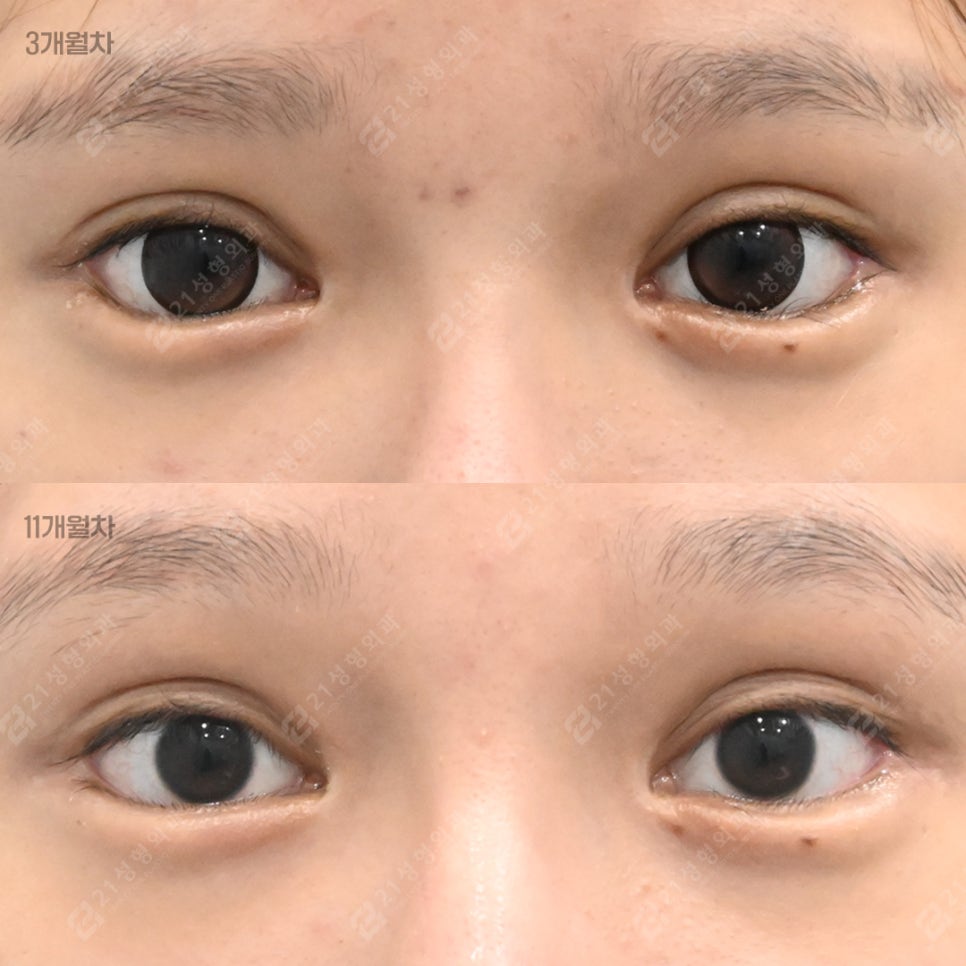The Golden Time to Correct Failed Eye Corners? Essential Checklist for Lateral & Lower Canthoplasty Revision image 6