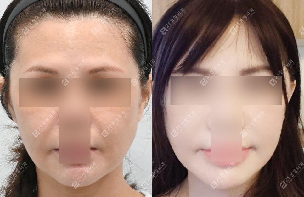 Face and Neck Lift: What Matters More Than Scars Is the Surgical Design image 7