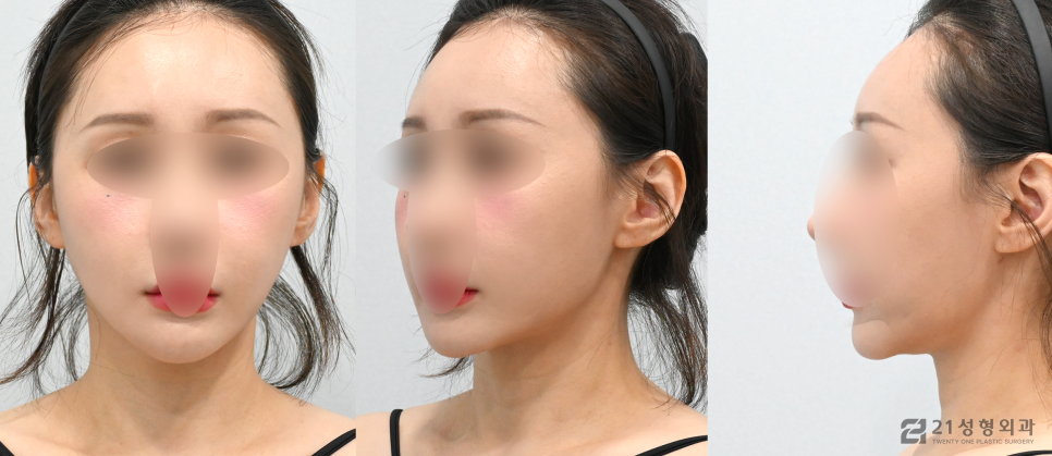 이중턱제거수술, 숨겨진 라인을 찾는 방법 관련 이미지 5