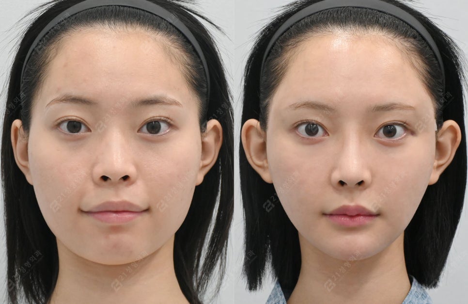 Facial Contouring, Key Points You Must Know: A Real Review of Changes Over 1 Year and 6 Months image 1