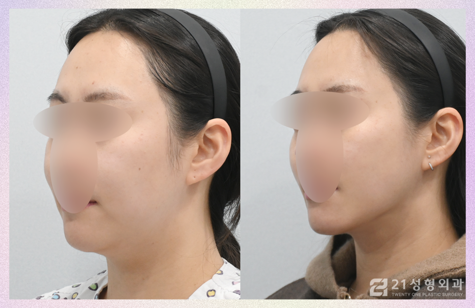이중턱지방제거 콤플렉스라면 관련 이미지 2