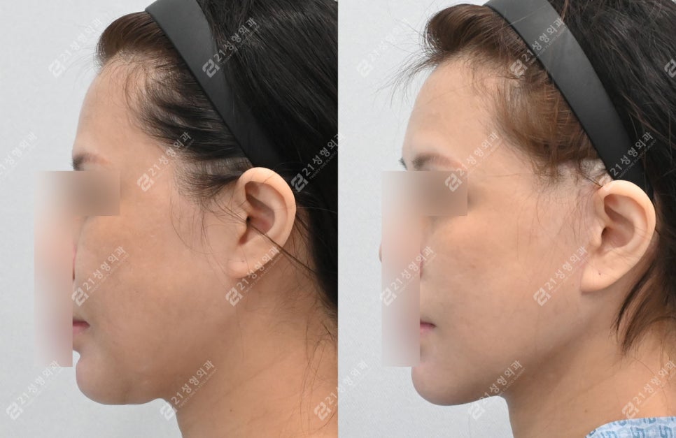 Face and Neck Lift: What Matters More Than Scars Is the Surgical Design image 6