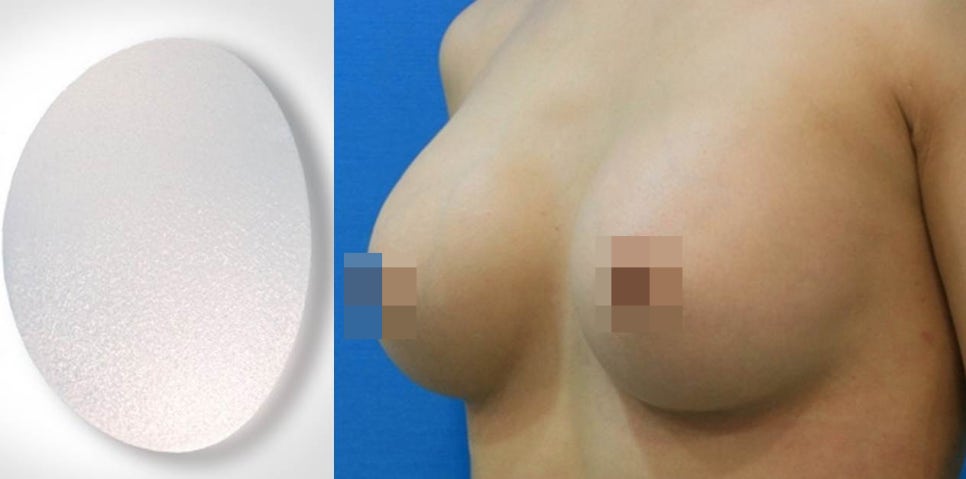 [가슴 수술] 보형물 모양 결정은 어떻게?   물방울? 라운드? 관련 이미지 8