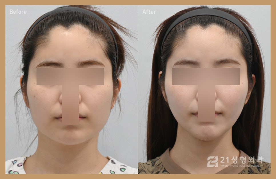 턱살제거수술로 매끈한 V라인 관련 이미지 1