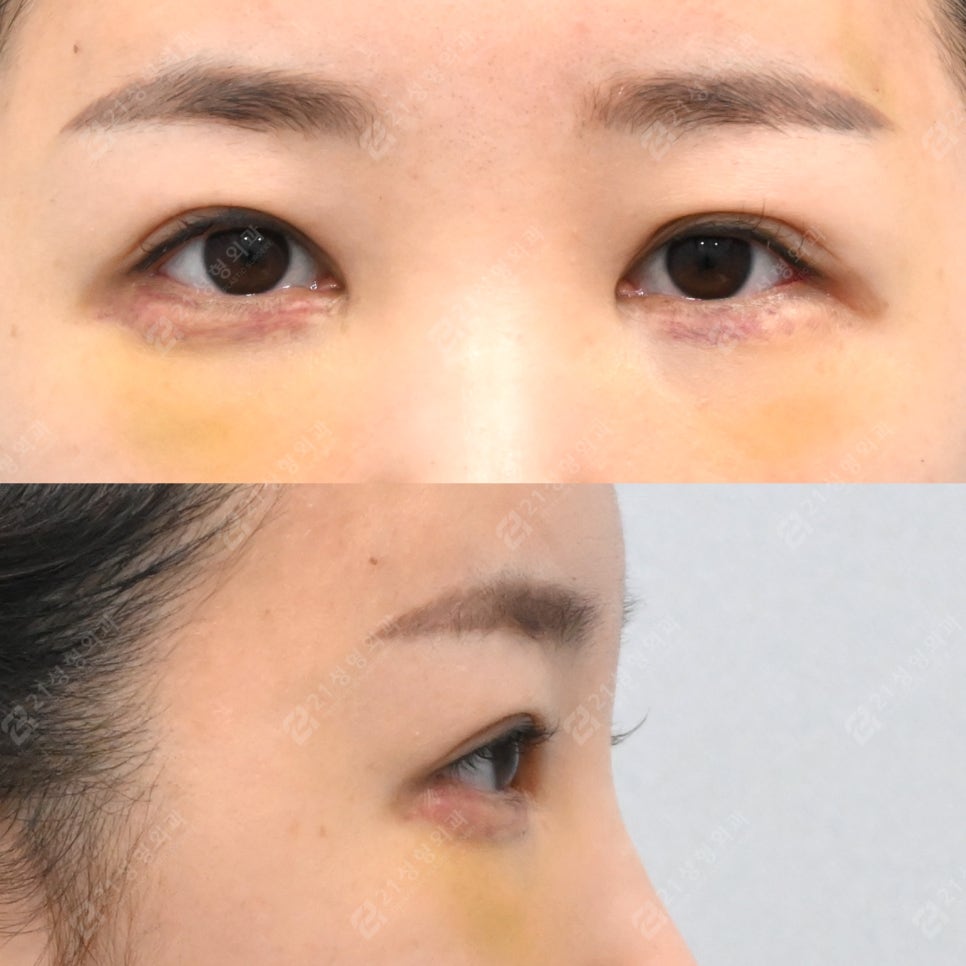 눈밑지방재배치 후 부기 오래가는 이유 관련 이미지 4