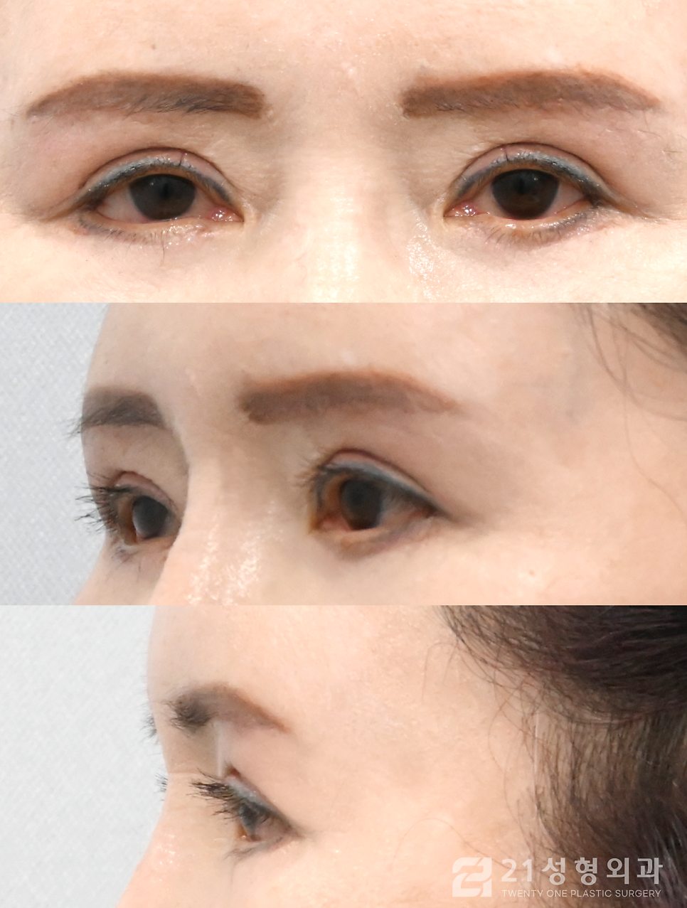 40대쌍수, 근본적인 원인부터 해결하자 관련 이미지 5