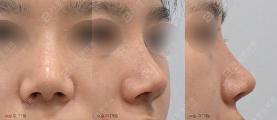 뭉툭한 코 완벽 해결? 21성형외과 원장이 밝히는 코 수술 황금 조합 관련 이미지 6