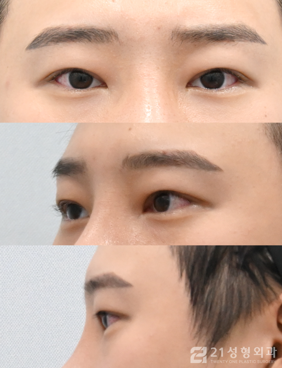 첫눈성형잘하는곳 아름다워지는 지름길 관련 이미지 5