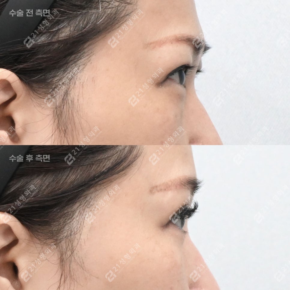 중년 눈성형, 눈썹하거상+하안검으로 자연스러운 동안 만들기! 관련 이미지 5