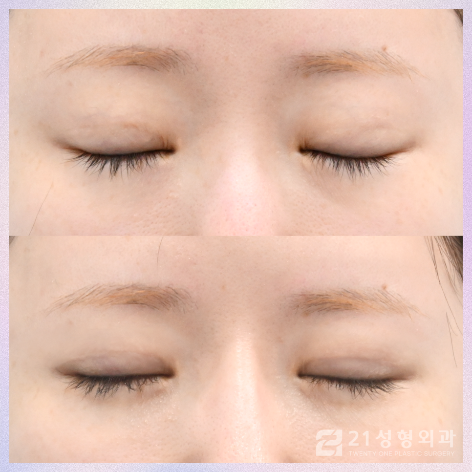 강남역쌍커풀수술 티 나지 않는 자연스러움 관련 이미지 2