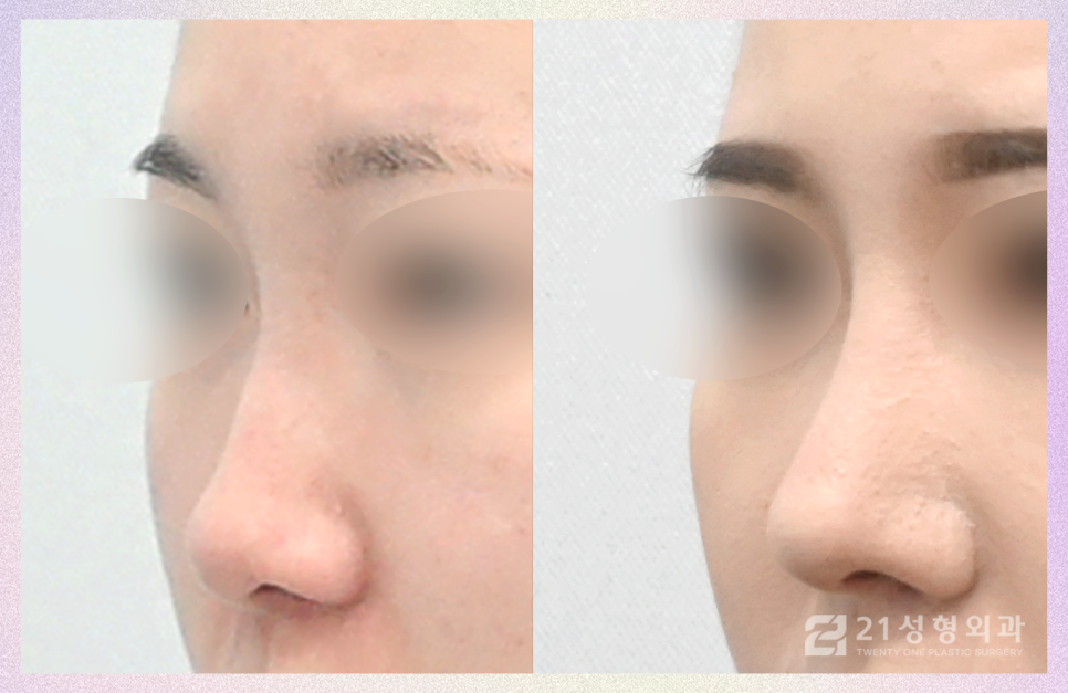 자가늑연골코성형 안전히고 아름다운 코 성형 관련 이미지 3