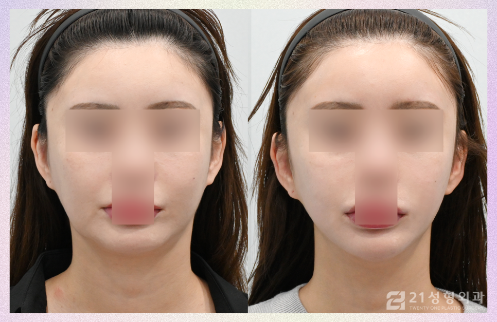 이중턱재수술은 근육묶기로 완성하자 관련 이미지 1