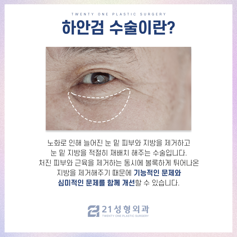강남하안검수술 처짐 없는 동안 눈매를 위해 관련 이미지 3