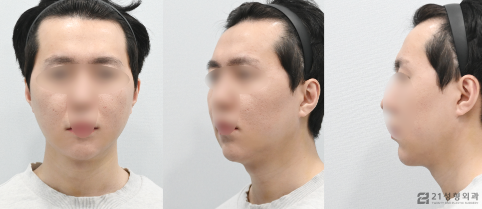이중턱살빼는방법 갸름한 얼굴라인 비결 관련 이미지 5